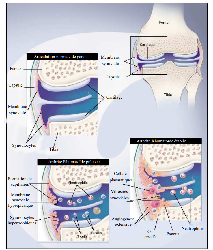 synoviale arthritique