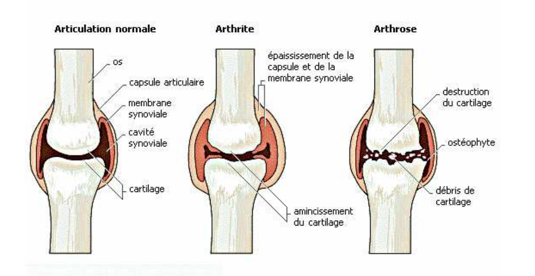 types courant de pathologies articulaires